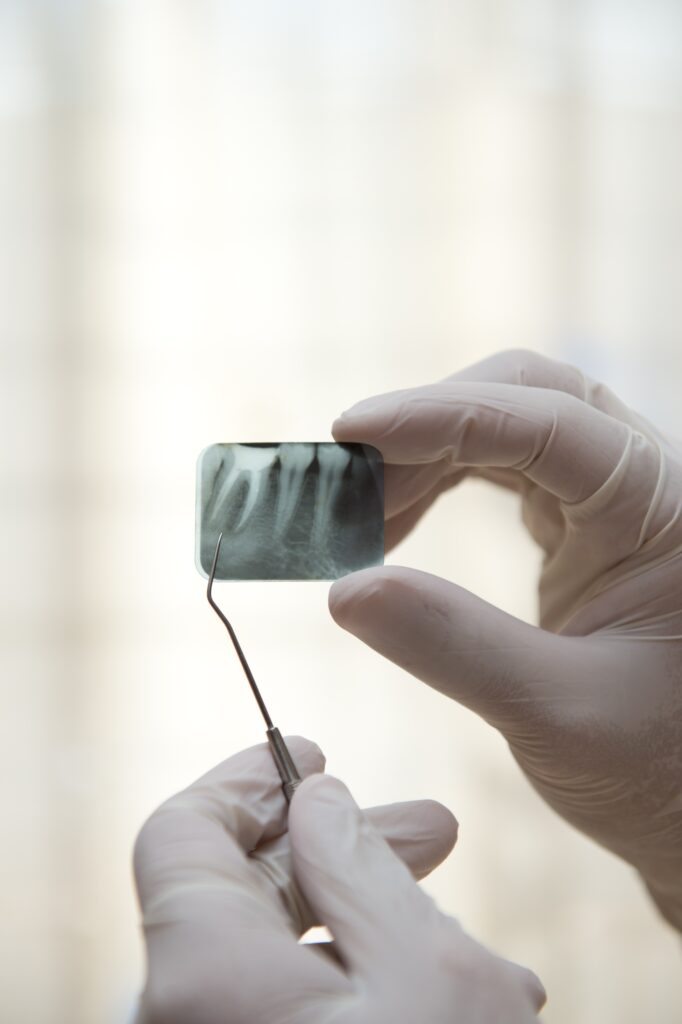 Endodonzia a Lanciano - D'Autilio Studio Odontoiatrico - devitalizzazione dente a Lanciano
