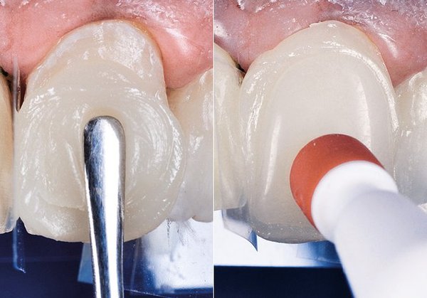 Faccette dentali a Lanciano- D'Autilio Studio Odontoiatrico