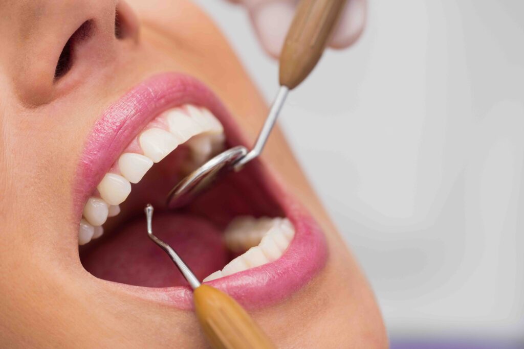 Come si fa otturazione dente