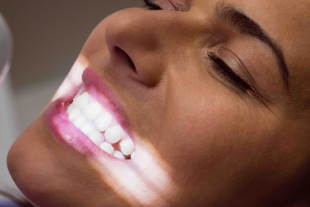 Come funziona lo sbiancamento denti