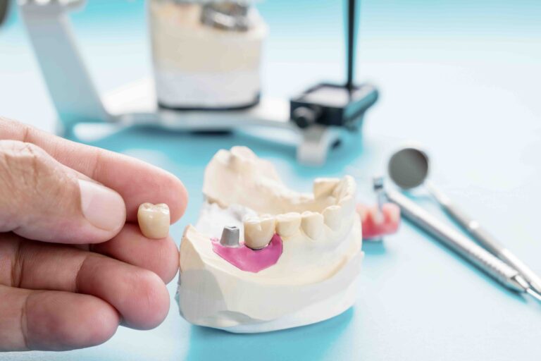 Rigetto dell’impianto dentale